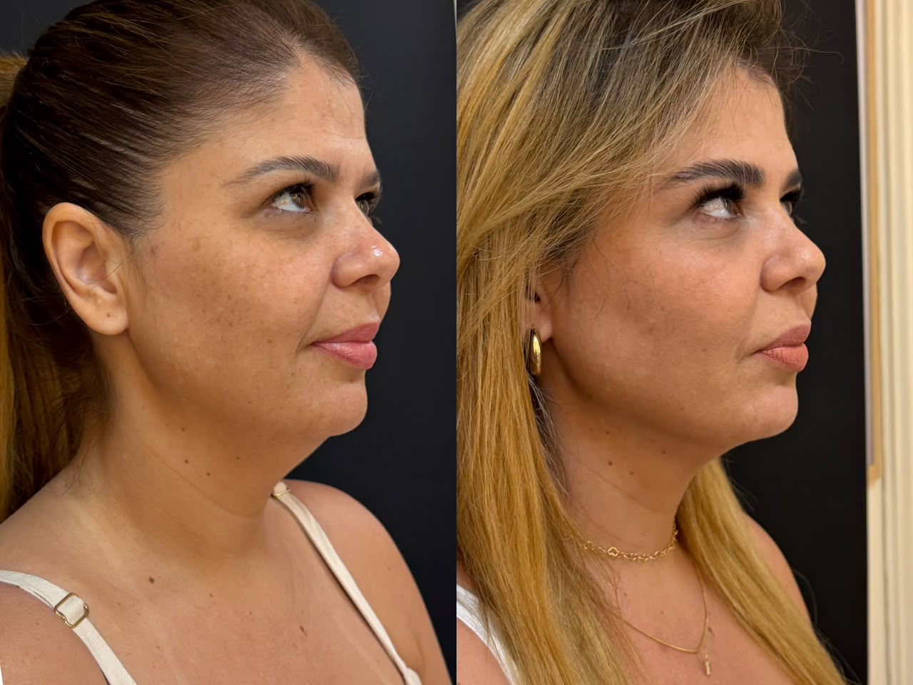 Lipo 3D de Papada - Contorno Facial Definido